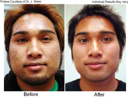 FotoFacial RF procedure Santa Barbara Before and After