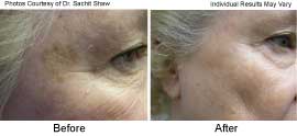 Skin Resurfacing With Fractional Co2 in Santa Barbara - Before and After Medical Spa Treatment