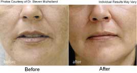 Skin Resurfacing With Fractional Co2