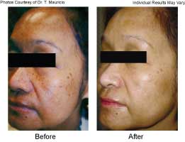 Skin Resurfacing With Fractional Co2 in Santa Barbara - Before and After Medical Spa Treatment