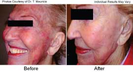 Skin Resurfacing With Fractional Co2 in Santa Barbara - Before and After Medical Spa Treatment