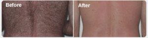 Before and After Photos of Laser Hair Removal in Santa Barabara Before and After Photos of Laser Hair Removal in Santa Barabara