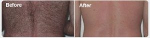 Before and After Photos of Laser Hair Removal in Santa Barabara