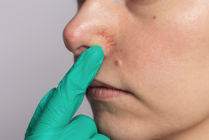 Laser Vein Removal