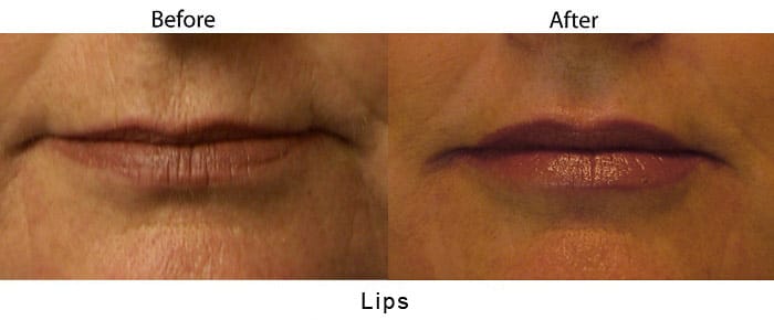 Subnasal Lip Advancement - Lip Lift | Evolutions Medical Spa