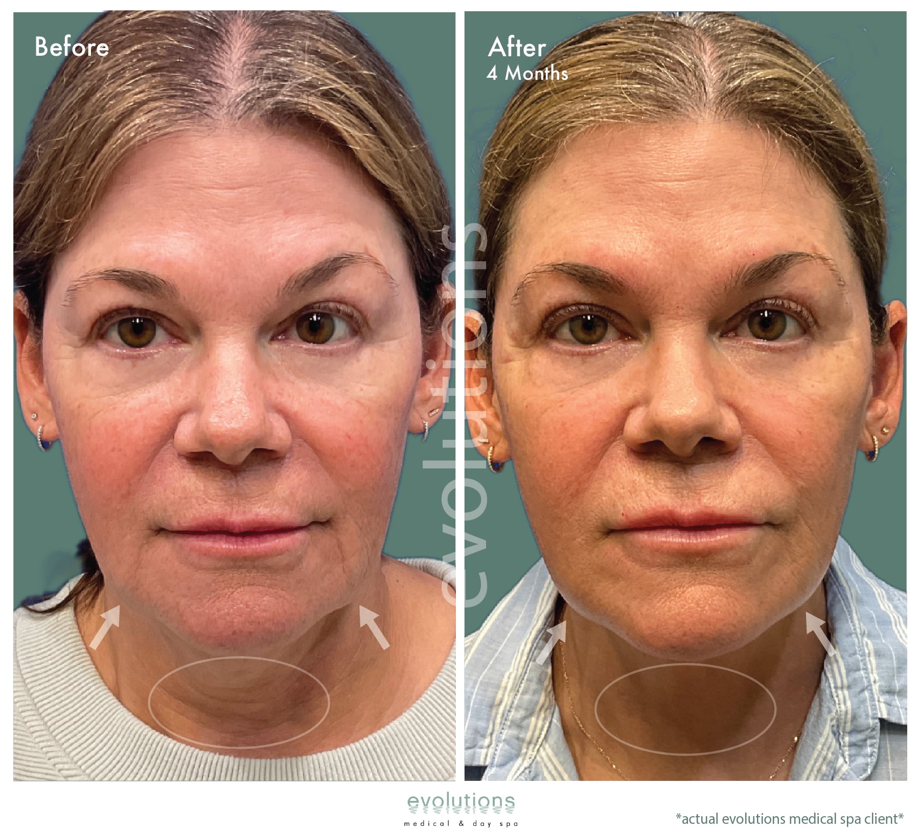 Ultherapy Lower Face Before and After