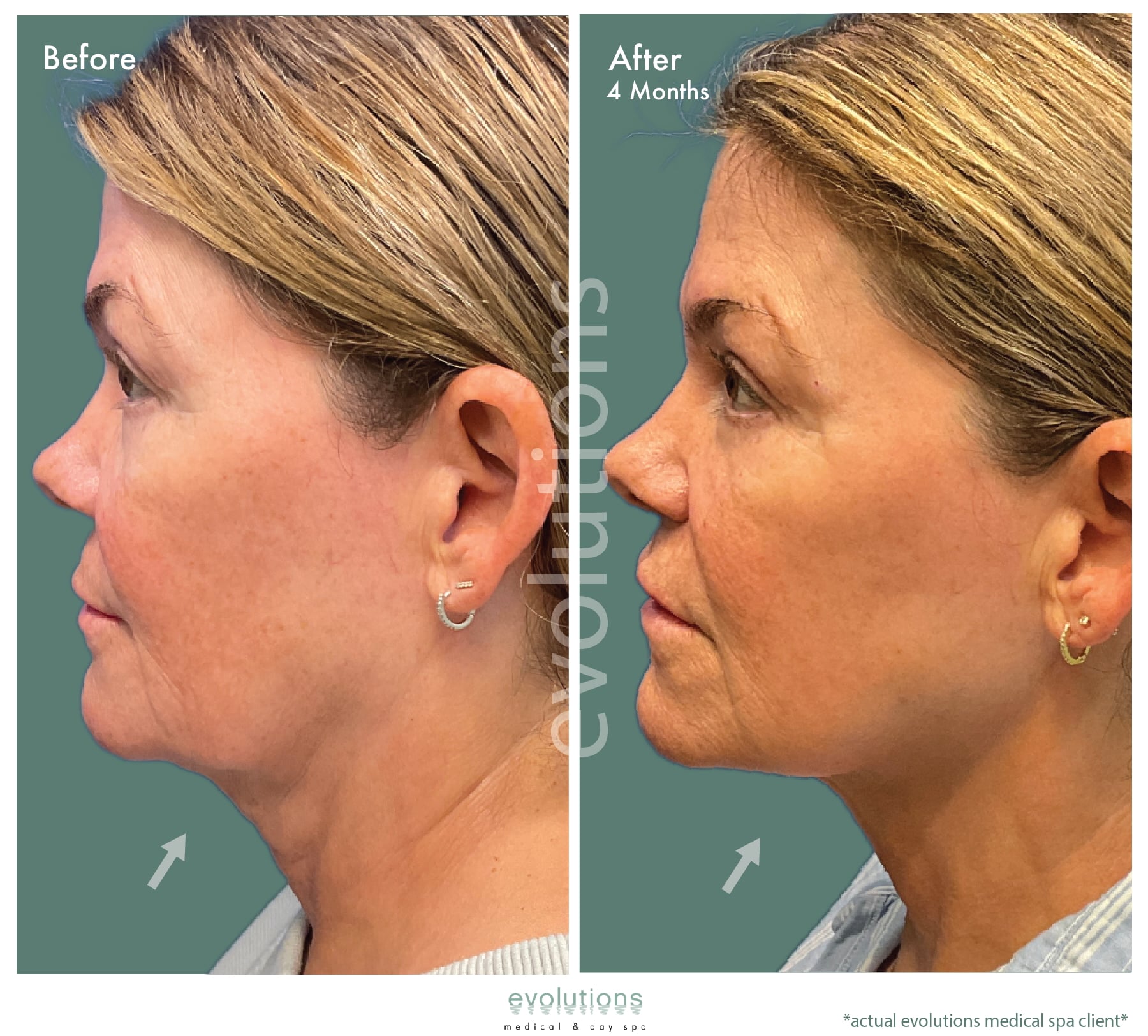 Ultherapy Lower Face Before and After