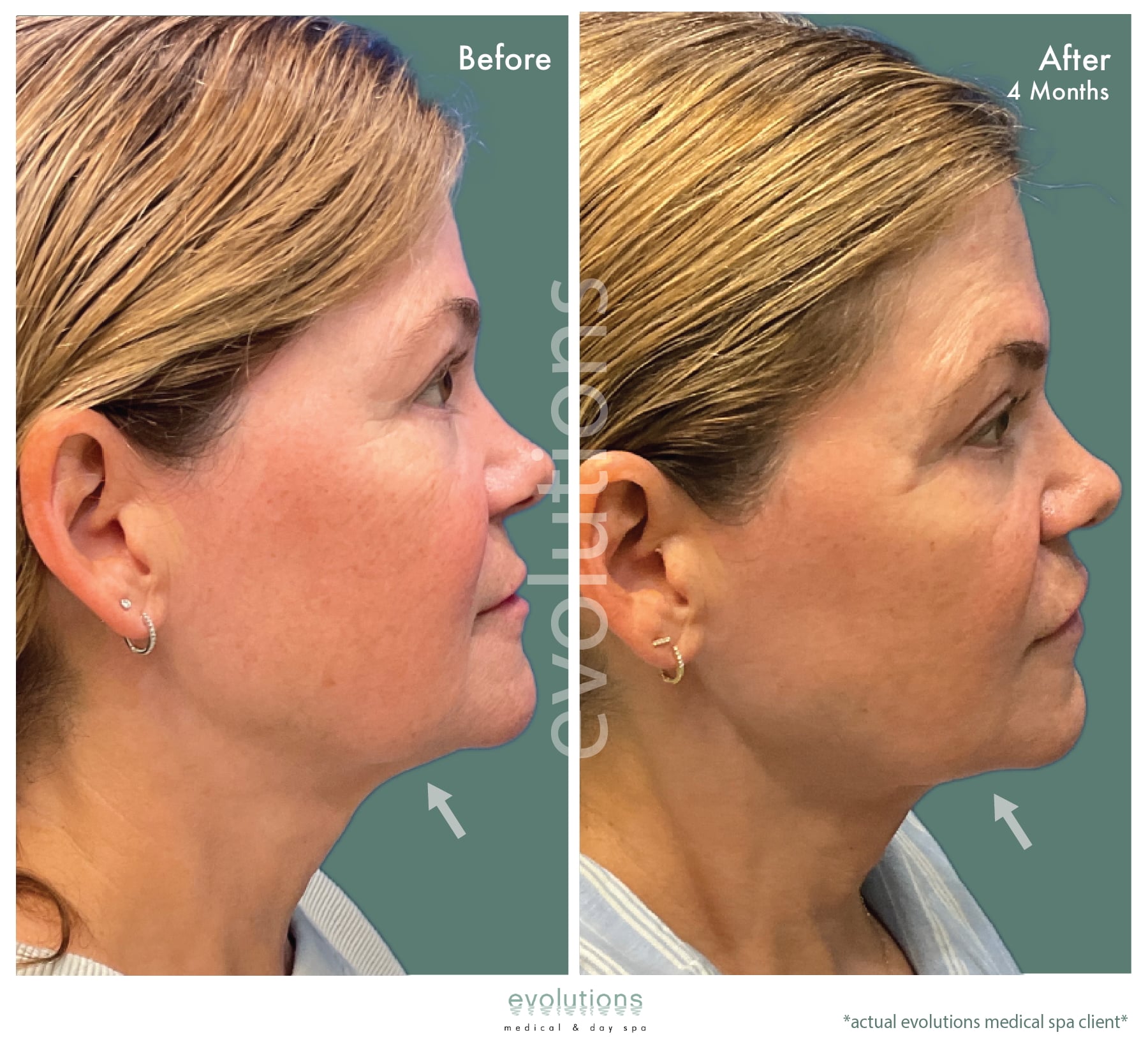 Ultherapy Lower Face Before and After