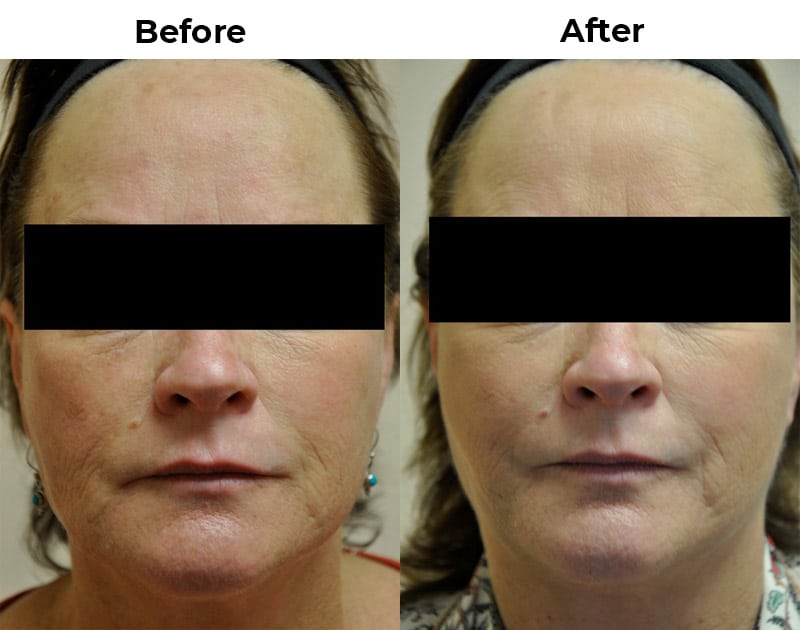Minimally Invasive (m.i.) Cheek Lift Before and After