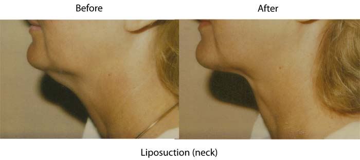 neck liposuction santa barbara