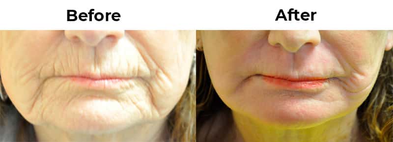 Chemabrasion Enhanced Skin Resurfacing on Lips Santa Barbara