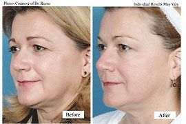 Skin Tightening Medical Spa Treatment in Santa Barbara - Before and After
