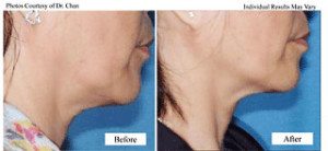 Skin Tightening Before and After Medical Spa Treatment in Santa Barbara
