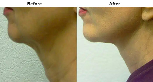 Sublime Skin Tightening: Before And After