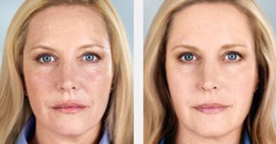 Sculptra Before And After