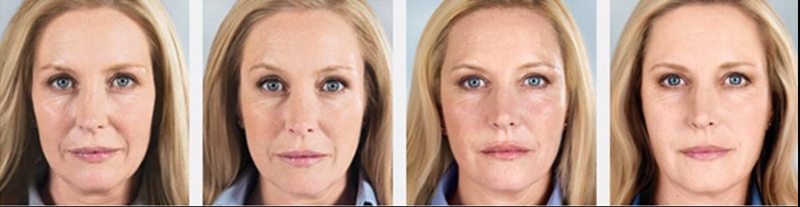 Sculptra Aesthetic - Collagen Replacement in Santa Barabara 