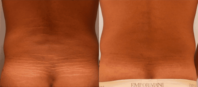 Before And After: Stretch Marks