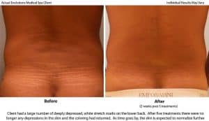 Stretch Mark Reduction in Santa Barbara - Evolutions Medical and Day Spa Services