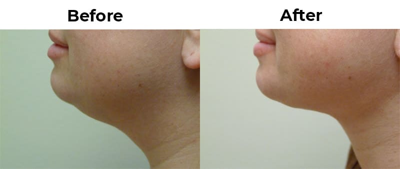 Facial Liposuction in Santa Barbara