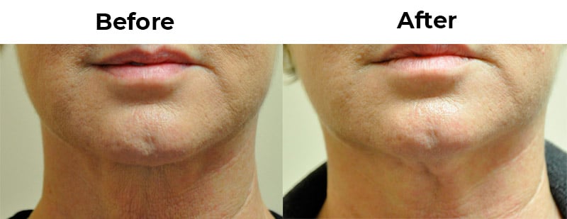 Submentoplasty (minimally Invasive “neck Lift”) Dr. Perkins sews the muscle bands together and removes extra skin to re-contour the neck and positively change the appearance and profile.