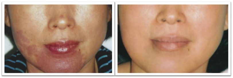 Treatments With Ellipse Ipl Courtesy Of Plong Panh Chak Ritha Md Thailand