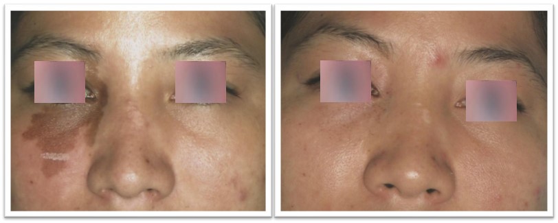 Treatments With Ellipse Ipl Courtesy Of Plong Panh Chak Ritha Md Thailand