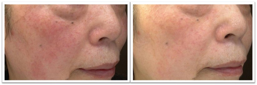 Treatments With Ellipse Ipl Applicator Pr Courtesy Of Harue Suzuki Md