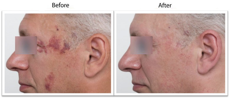 Ellipse IPL Before And After