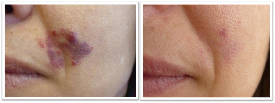 Treatments With The Ellipse Ipl Applicator Vl And Pr Courtesy Of Tomas Zamora Md Spain