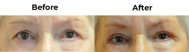 Blepharoplasty (eyelid Surgery – Upper Or Lower Lids)